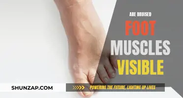 Visible Foot Injuries: What Do Bruised Muscles Look Like?