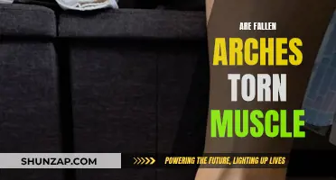 Fallen Arches: Torn Muscle or Something Else?