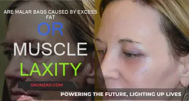 Understanding Malar Bags: Fat or Muscle Laxity?