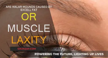 What Causes Malar Mounds: Fat or Muscle Laxity?