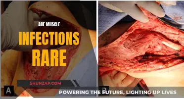 Muscle Infections: Uncommon but Understood