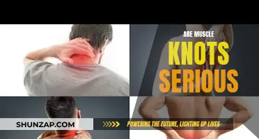 Muscle Knots: Understanding Their Severity and Impact