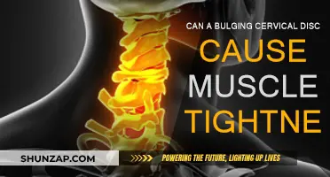 Cervical Disc Bulging: How It Causes Muscle Tightness