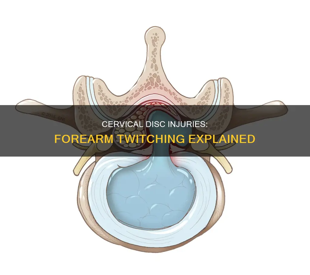 can a cervical disc injury cause forearm muscle twitching
