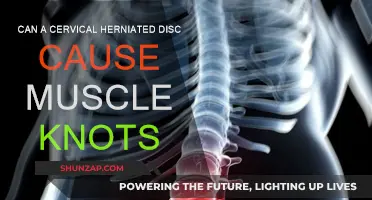 Cervical Herniated Discs: The Link to Muscle Knots