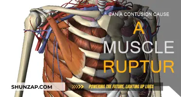 Contusion-Related Muscle Rupture: Is There a Link?