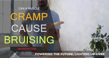 Muscle Cramps: The Surprising Cause of Bruises