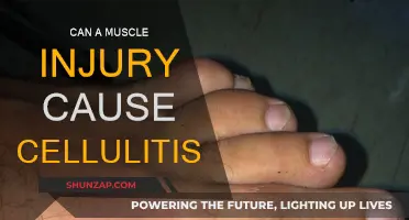 Muscle Injuries: A Cellulitis Risk?