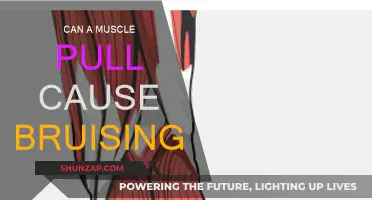 Muscle Pulls: Can They Cause Bruising?