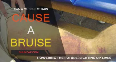 Muscle Strains: Can They Cause Bruising?