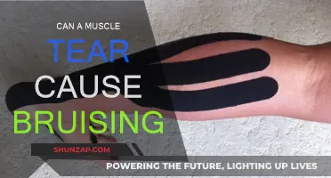 Muscle Tears: Understanding Bruising and Healing