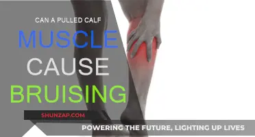 Pulled Calf Muscle: Why Does Bruising Occur?