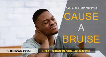 Pulled Muscles: Why Bruising May Occur and How to Treat It