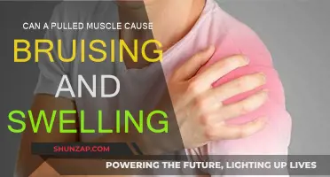Pulled Muscle: Bruising and Swelling Explained
