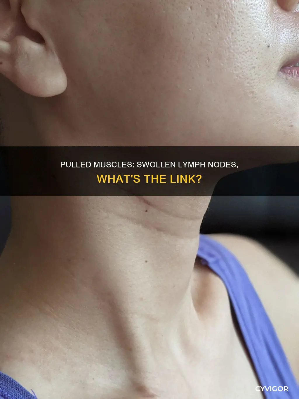 can a pulled muscle cause swollen lymph nodes