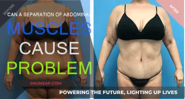 Abdominal Muscle Separation: What Are the Risks?