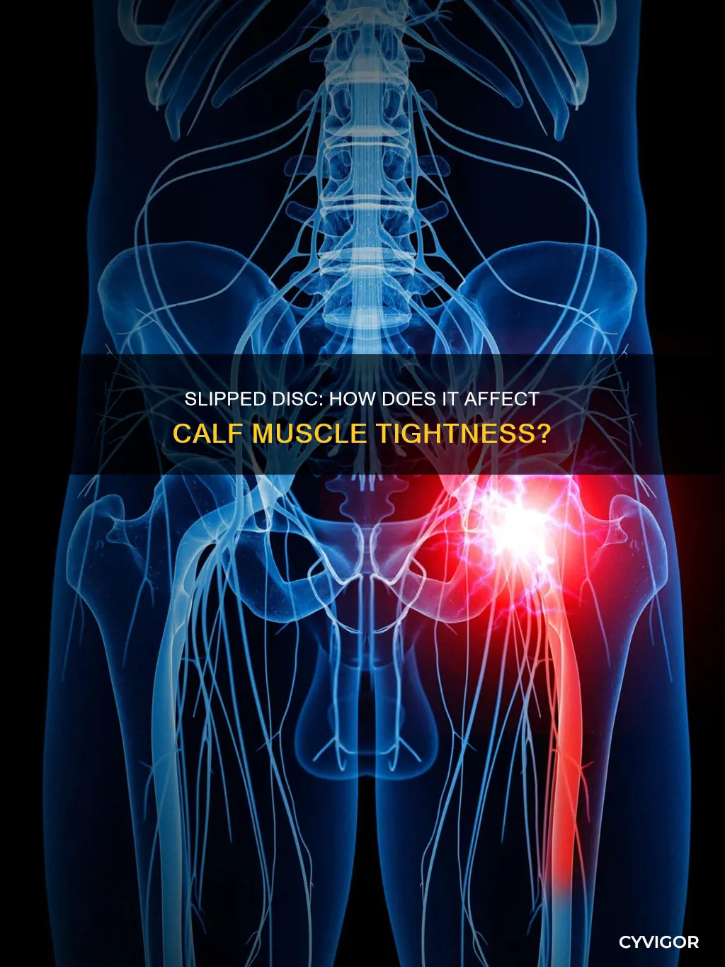 can a slipped disc cause tight calf muscles