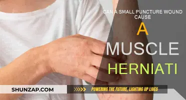 Small Puncture Wounds: Unseen Muscle Herniation Risk