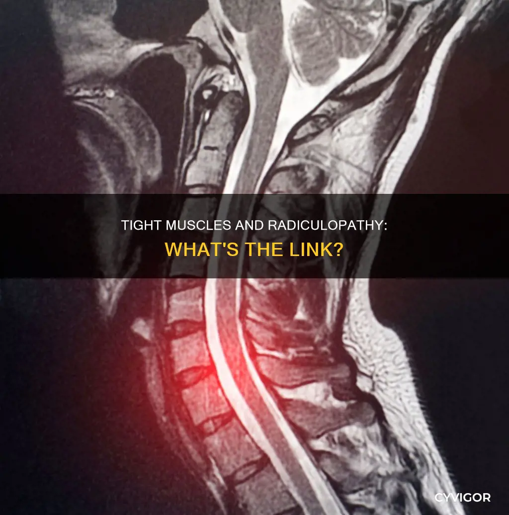 can a tight muscle spasm cause radiculopathy