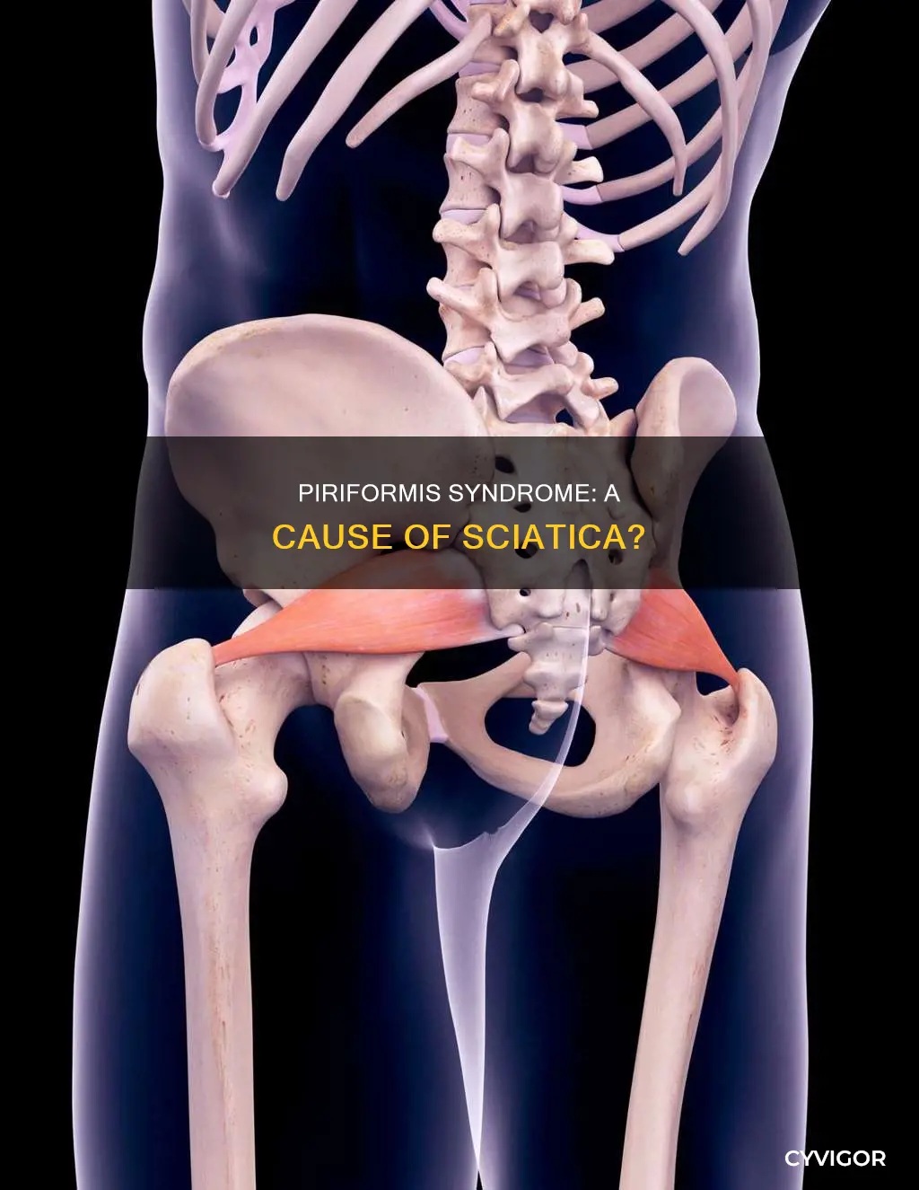 can a tight piriformis muscle cause sciatica