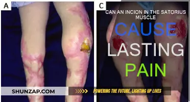 Incion in the Satorius Muscle: Understanding Lasting Pain