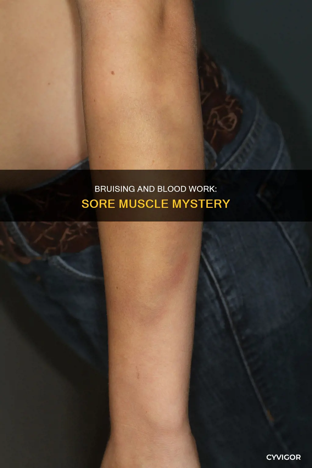 can bloodwork that bruises cause sore muscles
