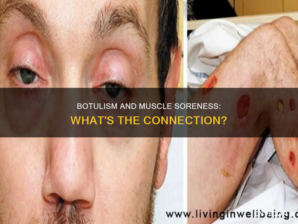 can botulism cause muscle soreness