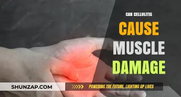 Cellulitis and Muscle Damage: What's the Link?