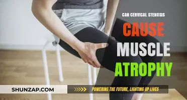 Cervical Stenosis: Muscle Atrophy and Treatment