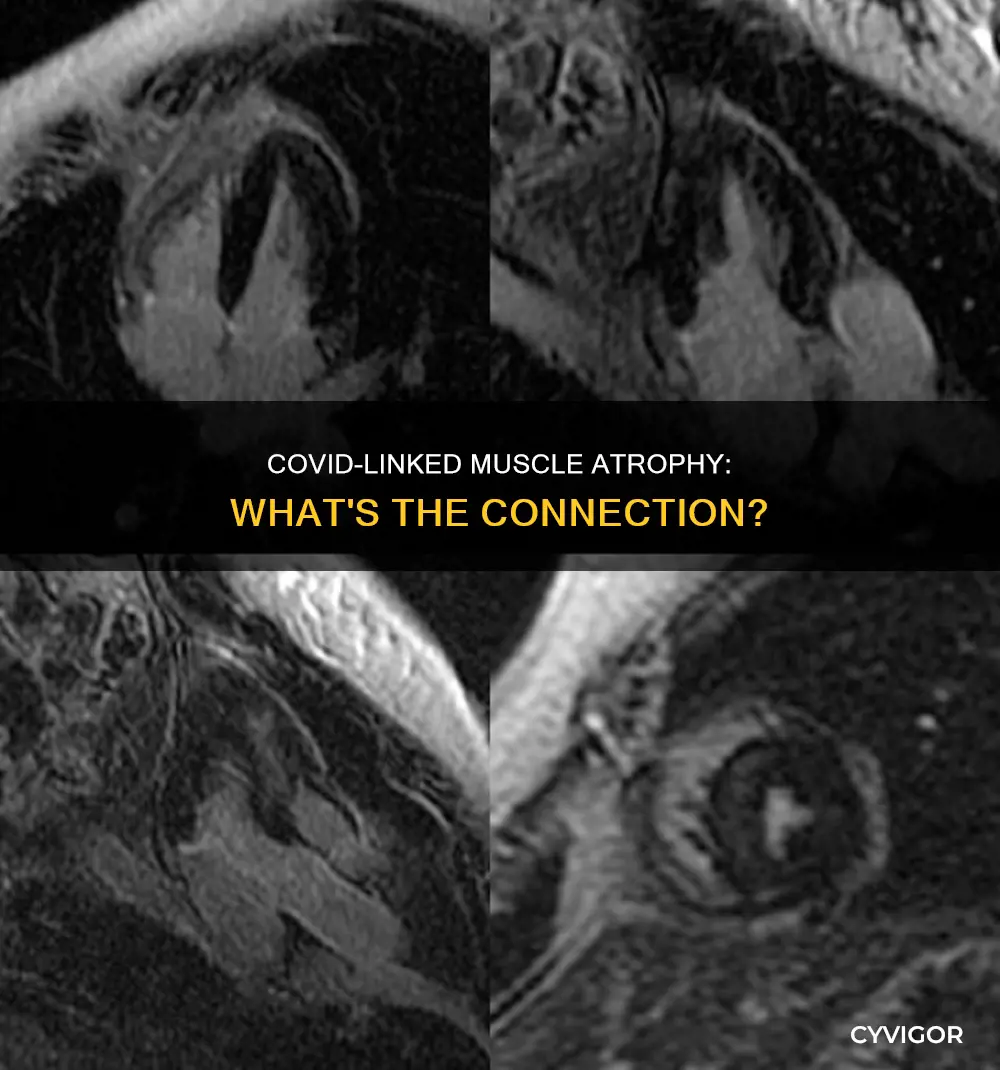 can covid cause muscle atrophy