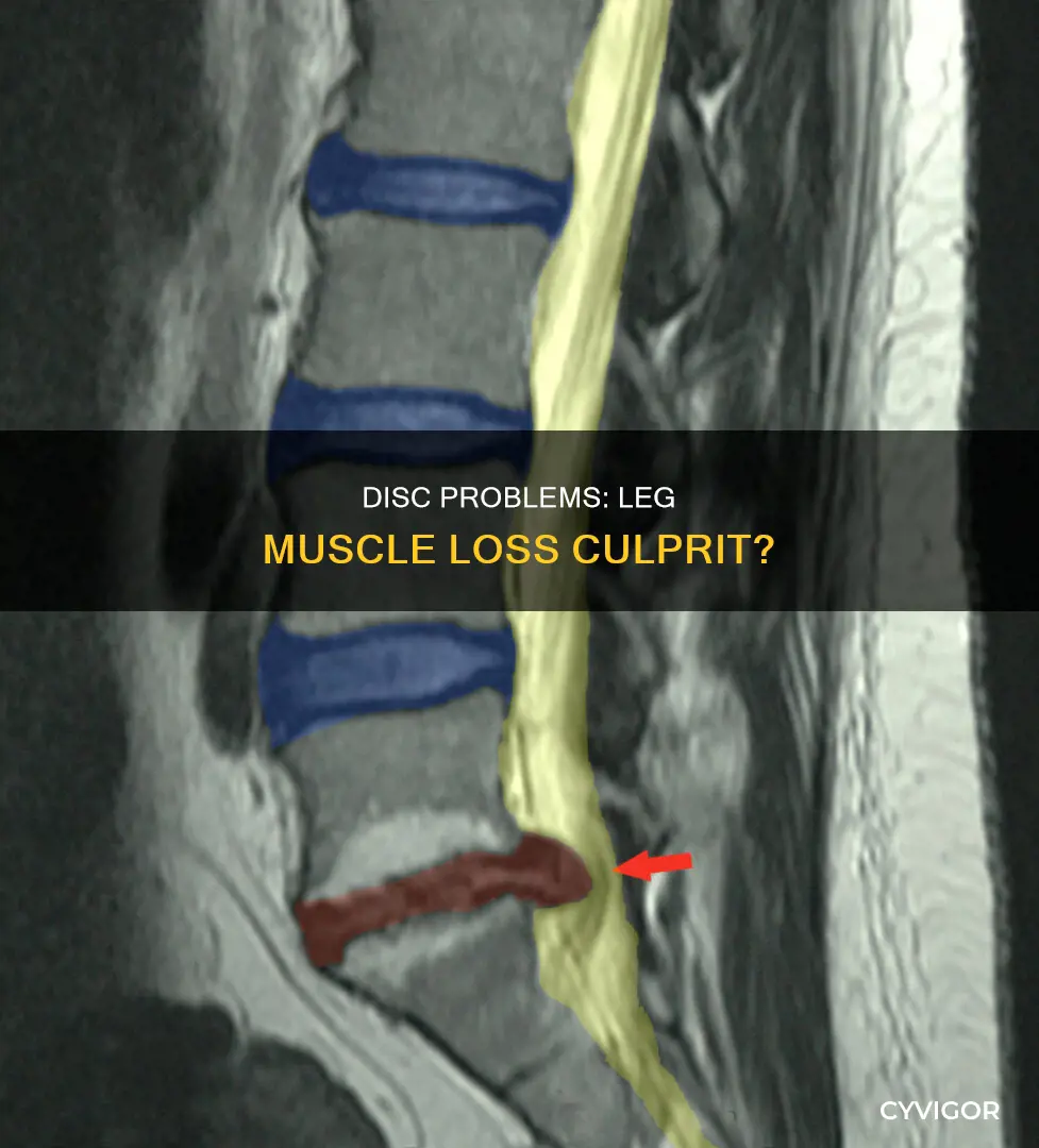 can disc problem cause muscle lost in legs