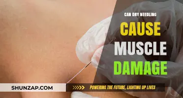 Dry Needling: Risks of Muscle Damage and Treatment