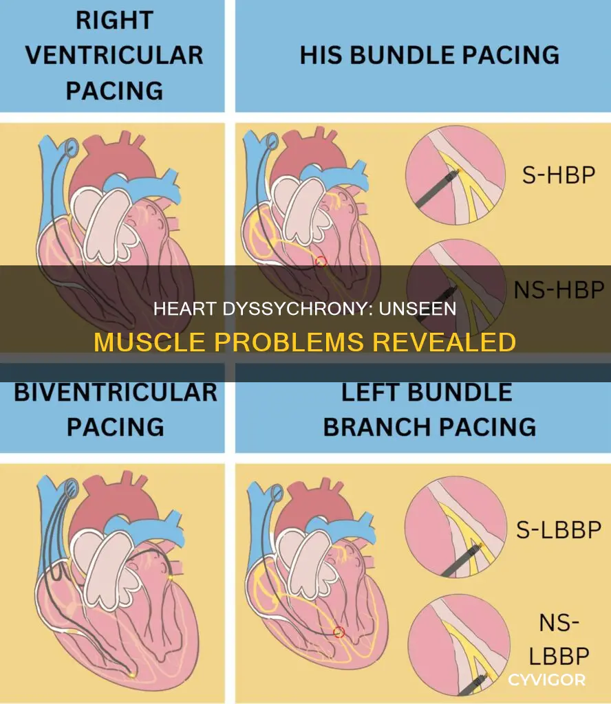 can dyssychrony of the heart cause muscle problems
