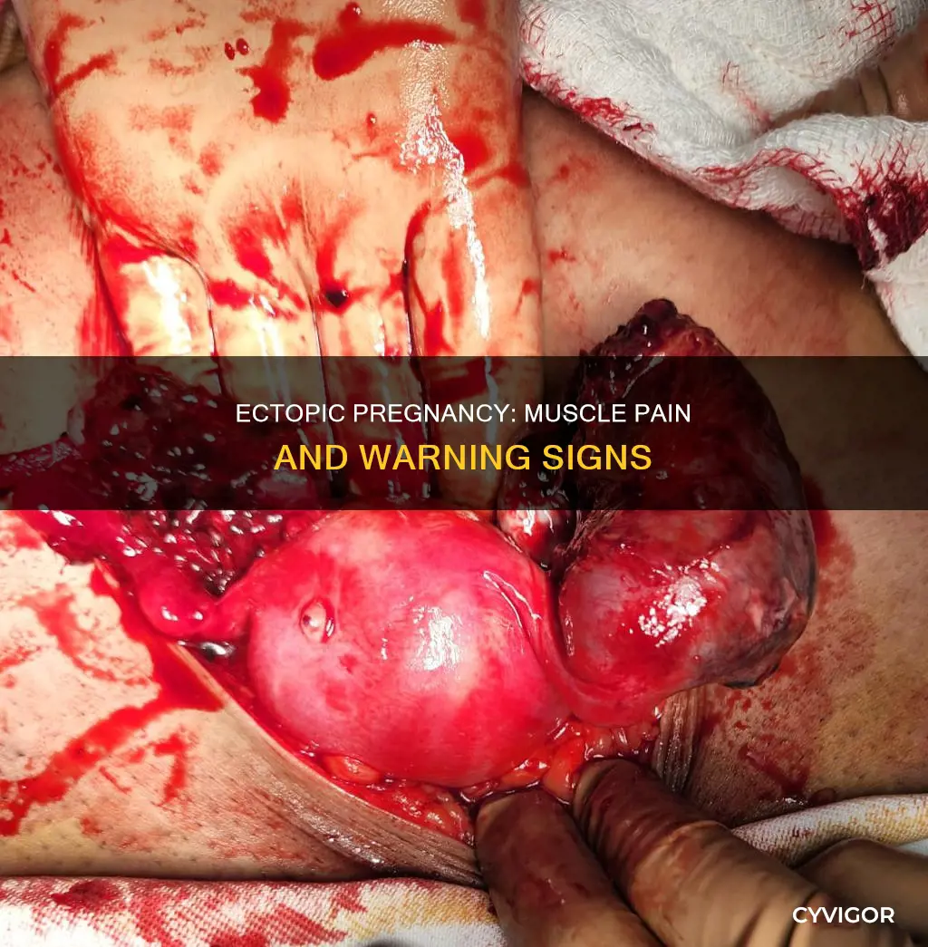 can ectopic pregnancies cause muscle pain