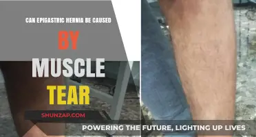 Muscle Tears and Epigastric Hernias: What's the Link?