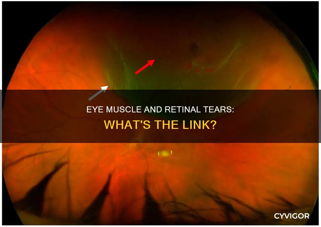 can eye muscle cause tear on retina