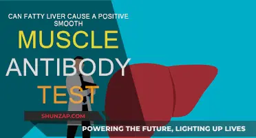 Fatty Liver and Smooth Muscle Antibodies: A Connection?
