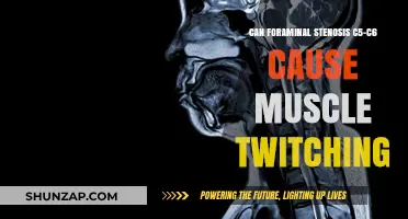 Muscle Twitching and Foramina: C5-C6 Connection?