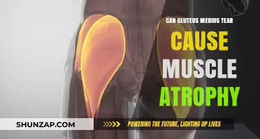 Gluteus Medius Tears: Understanding Muscle Atrophy Risks