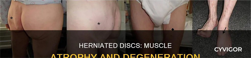 can herniated disc cause muscle atrophy