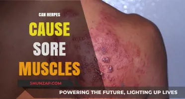 Herpes and Sore Muscles: Is There a Link?