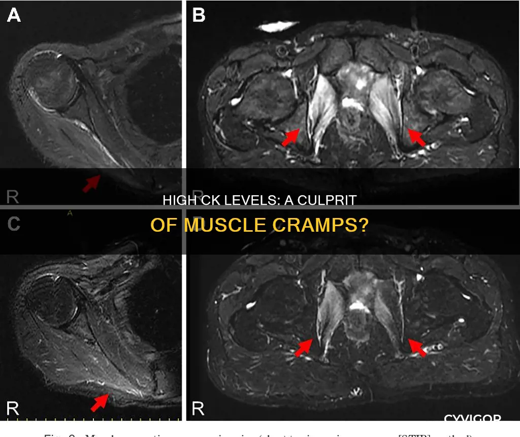 can high ck levels cause muscle cramps