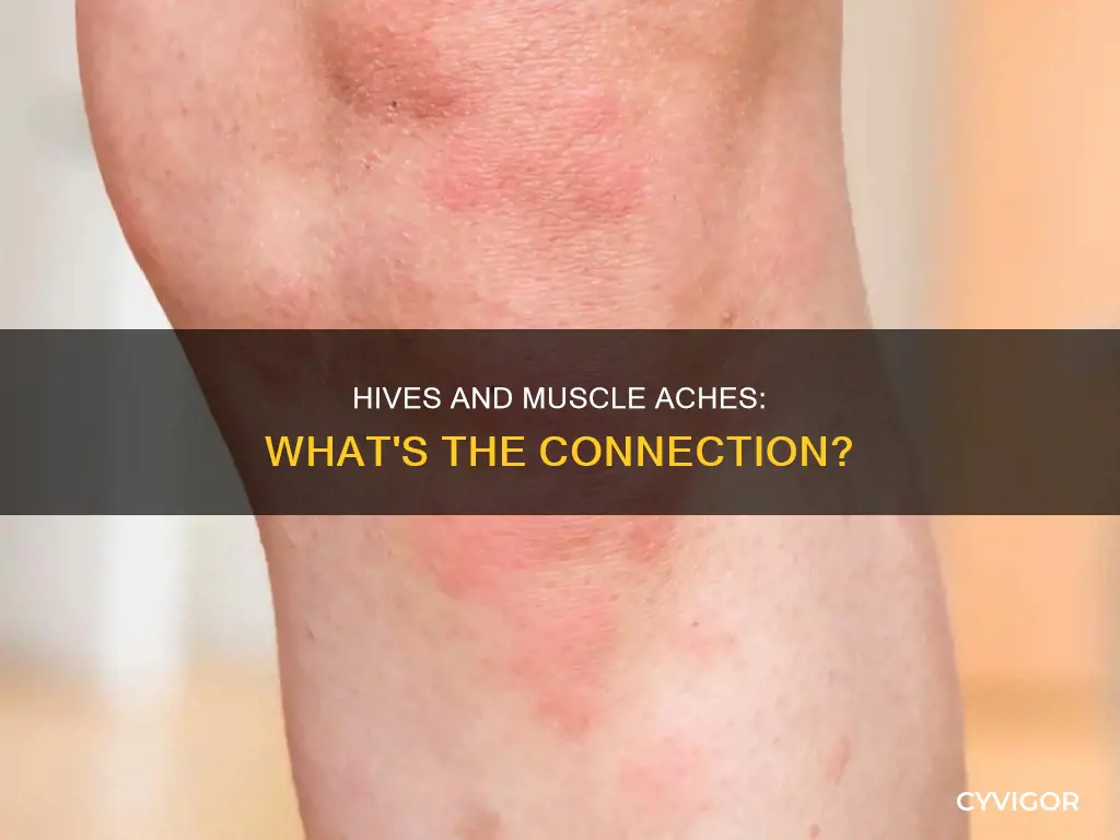 can hives cause muscle aches