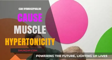 Hydrocephalus and Muscle Hypertonicity: Is There a Link?