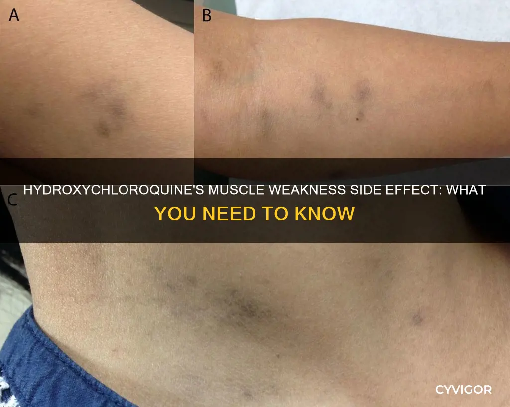 can hydroxychloroquine cause muscle weakness