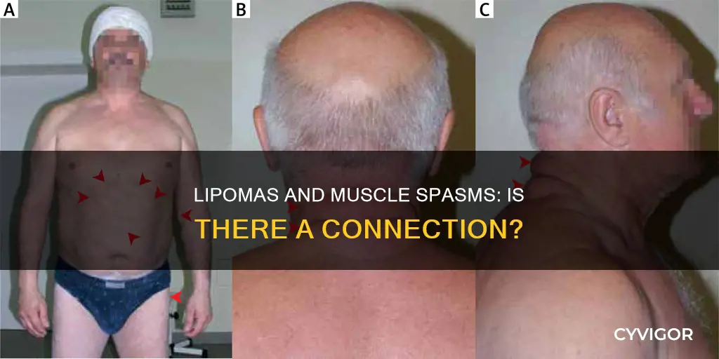 can lipomas cause muscle spasms