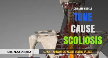 Low Muscle Tone: A Scoliosis Cause?