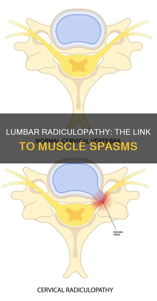 can lumbar radiculopathy cause muscle spasms