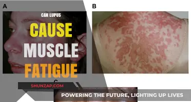 Lupus and Muscle Fatigue: Understanding the Connection
