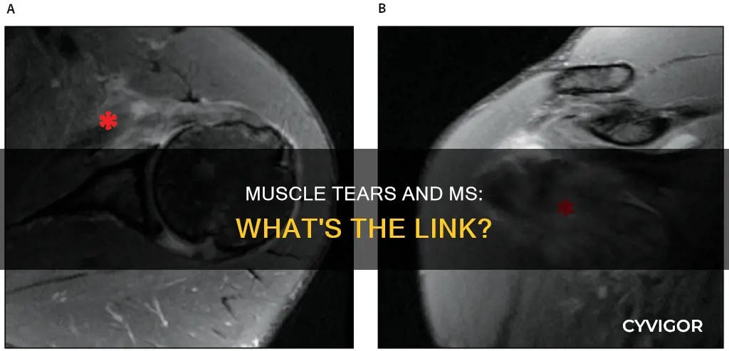 can ms cause muscle tears